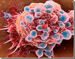 Раковая клетка